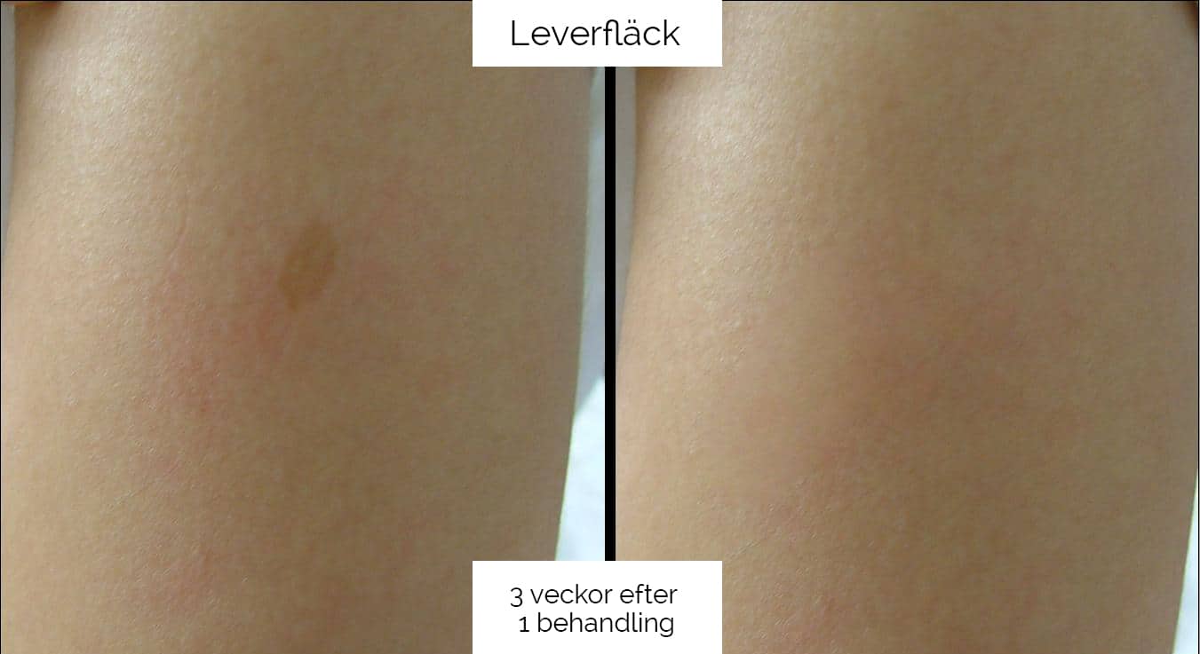 Köp Pastelle Q-switched nd:YAG Laser | BeautyLight™